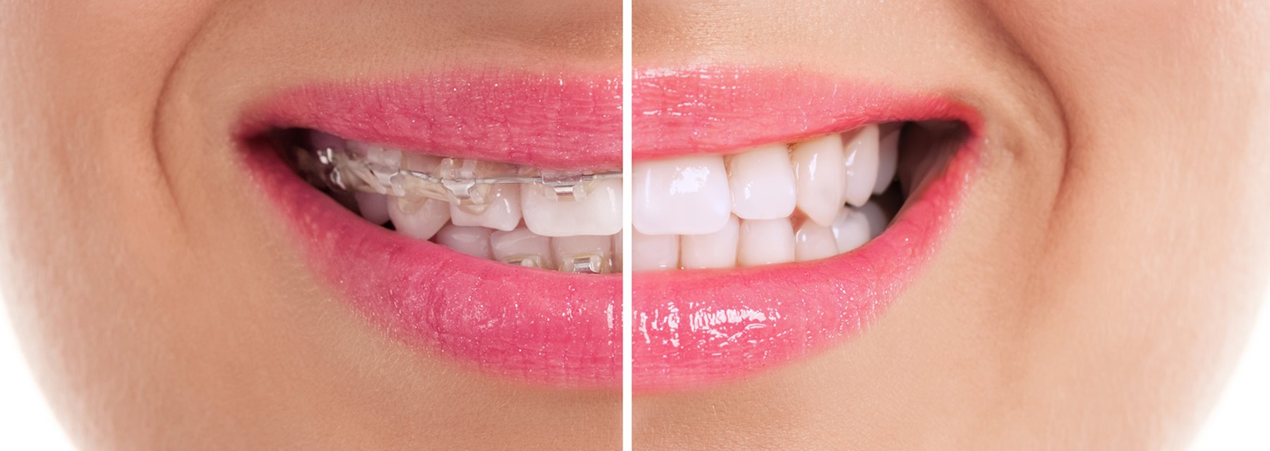 Before & After Effect - Lakewood in Colorado